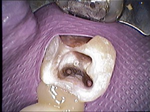 08-Kofferdam mesial fixiert