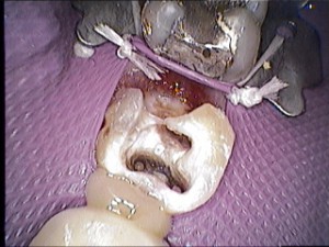 09-Kofferdam nach distal gebunden