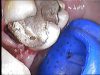 04-subgingivale-karies-36-37